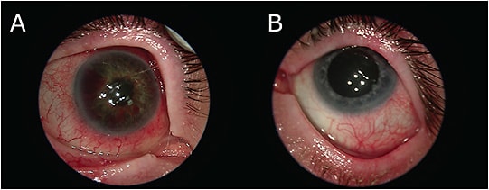 FIGURE 1: External slit lamp photographs of the 49-year-old patient’s eyes. The right eye (A) demonstrates conjunctival injection with 360° posterior synechiae, neovascularization of the iris, and hyphema; the left eye (B) shows quiet anterior chamber and no hyphema or synechiae. IMAGES COURTESY BETH SNODGRASS