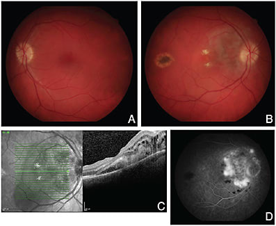 FIGURE 1: On initial presentation, the patient’s left eye demonstrated normal appearance on fundus imaging with the exception of stable mild chronic disc edema (A), while fundus photography of the right eye revealed similar chronic mild optic disc edema, but with a variably pigmented peripapillary lesion with retinal thickening and exudate extending from the disc towards the fovea. The hyperpigmeted lesion temporal to the macula in the right eye was a pre-existing scar (B). Optical coherence tomography (OCT) showed intraretinal and subretinal fluid as well as distortion of the outer retinal architecture (C). Fluorescein angiography revealed late leakage and hyperfluorescence in the right eye (D).IMAGES COURTESY RAY MOK