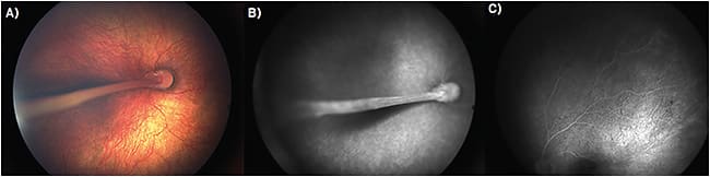FIGURE 1. (A) Funduscopic examination showed the radial fold extending from the optic disc to the temporal periphery in the right eye, and inserting toward the ciliary processes and attached to the temporal lens capsule by fibrotic tissue. (B) Widefield fluorescein angiography (FA) in the right eye revealed retinal vasculature within the radial fold and peripheral avascular retina. (C) In the left eye, FA revealed peripheral avascular retina and anomalies at the vascular tips.