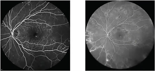 FIGURE 2: Widefield angiography in real-life practice changed the diagnosis severity and management by enabling us to detect more areas of pathology with broader classifications based on broadening of what we get from the retinal periphery.