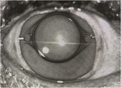 FIGURE 2: Radial fixation technique in a trauma patient with missing inferior iris. Gore-Tex suture is visible in the eyelets.