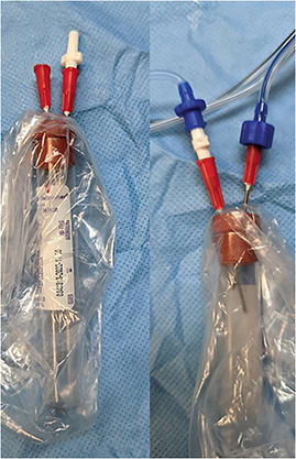 FIGURE 4: Left, photo of red-top tube connected to 18-gauge needles and connector. Right, photo of red-top tube connected to the vitrector. IMAGE COURTESY MUSA ABDELAZIZ, MD