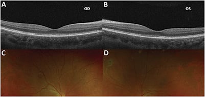 FIGURE 4: OCT scans at 3 month follow-up show resolution of subretinal fluid, pigment epithelial detachments, and bacillary layer detachments (A, B). Optos ultrawidefield fundus photos at 3 month follow-up reveal significant improvements in corresponding subretinal multifocal lesions in the posterior pole of both eyes (C, D). IMAGE COURTESY TIMOTHY S. LEE