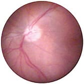 FIGURE 1: Endoscopic image of the posterior pole of the retina. The surgeon should orient the endoscopic image to match the microscope image. IMAGE COURTESY RUPAN K. TRIKHA, MD