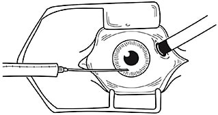 FIGURE 1: Anterior chamber paracentesis in a phakic patient
