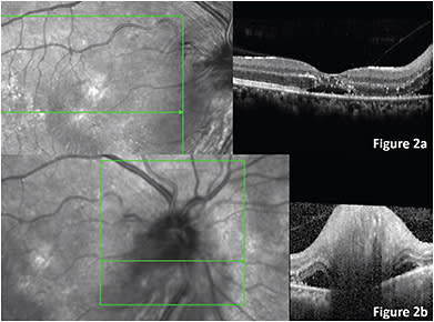 FIGURE 2: SD-OCT, macula. Incomplete posterior vitreous detachment is observed, and epiretinal membrane traces with mildly elevated foveal contour. Hyperreflective dots between the external limiting membrane and inner nuclear layer can be observed. Presence of subfoveal subretinal fluid (SRF), and SRF nasally in the peripapillary area (A). SD-OCT of the ONH; ON swelling can be observed with SRF surrounding the ON (B).