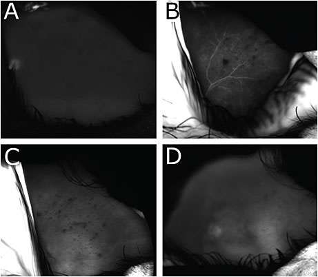 FIGURE 4: Fluorescein angiography of the left eye showing early optic disc leakage (A) and vascular staining (B) without obvious vascular leakage with blocked fluorescence in the areas of the chorioretinal infiltrative lesions in late frames (C and D). IMAGES COURTESY BETH SNODGRASS