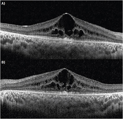 FIGURE 2. (A) OCT, right eye; (B) OCT, left eye. Symmetrical cystoid macular edema present, with outer retinal atrophy present outside the fovea.