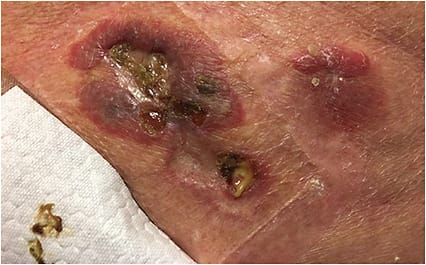 FIGURE 1. Skin lesions with purulent discharge.