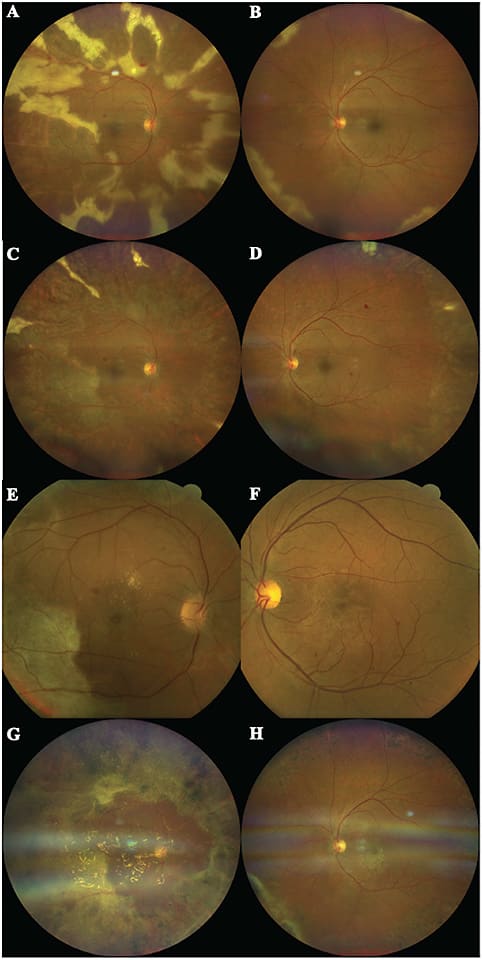 FIGURE 1. Fundus photograph of both eyes on initial presentation (A, B) with worse retinitis in the right eye. Three weeks after initial presentation (C, D) the retinitis in both eyes has stabilized. Two months after initial presentation (E, F), prior to pars plana vitrectomy in the right eye. Four months after PPV (G, H), with attached retina in the right eye and prophylactic barrier laser in the left eye. Photos taken with Zeiss Clarus 700 fundus camera. IMAGES COURTESY VENKATKRISH M. KASETTY, MD; DHRUV SETHI, MD, MBA, MPH; AND EVGENY GELMAN, MD.