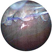 FIGURE 5: Endoscopic image of IOL haptic abrading ciliary body (CB) processes, causing chronic inflammation and recurrent vitreous hemorrhage. Laser application to the associated CB will reduce the inflammation and bleeding. IMAGE COURTESY RUPAN K. TRIKHA, MD