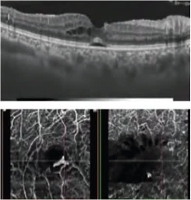 FIGURE 4: OCT and OCT-A in management of DME.