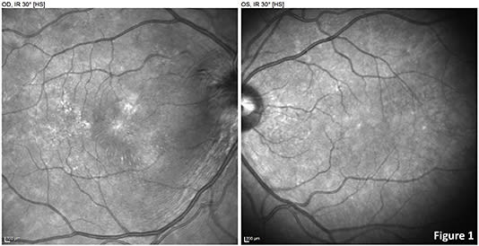 FIGURE 1: SLO infrared posterior pole. In OD, a hyperreflective macular star-shaped pattern can be observed, as well as optical nerve head swelling.