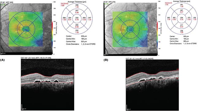 FIGURE 2: After the patient abstained from intense exercise for a six-week period, there was a striking resolution of fluid, shown on before (A) and after (B) images of the right eye. Images taken with a Heidelberg Spectralis OCT. IMAGE COURTESY DAVID HUNT, MD, FACS