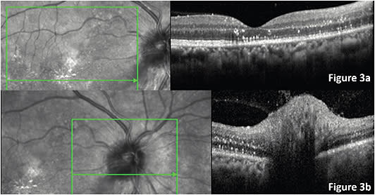 FIGURE 3: SD-OCT, 8 days after treatment, in both macular and ONH sections, resolving of SRF can be observed with persistence of hyperreflective dot.