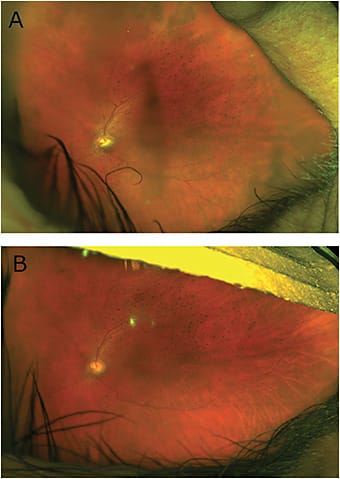 FIGURE 7: Widefield fundus images of the left eye at month 2 (A) and month 6 (B) after initiation of antibiotic therapy demonstrate significant improvement in vitreous haze and snowballs and reduction in size of infiltrative lesion along superior arcade. IMAGES COURTESY BETH SNODGRASS