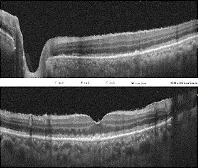 FIGURE 3: OCT of patient in Figure 1. Note mild hyperreflective deposits between RPE and Bruch’s membrane and RPE undulations. IMAGE COURTESY MUSA ABDELAZIZ, MD