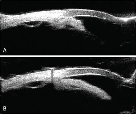 FIGURE 1: Ultrasound biomicroscopy (UBM) shows the angle of patient’s dilated left eye at presentation (A). The iris is folded between the lens and the angle. In UBM of the left eye in the same position 10 days later (B), after LPI and undilated, the lens is resting over the rounded lens capsule.IMAGE COURTESY GARETH LEMA, MD