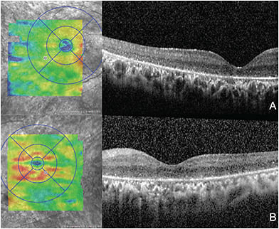 FIGURE 3: OCT image of both eyes. The inner and outer segments appear attenuated with overall thinning noted on en face, involving the fovea in the right eye (A). Similar findings are demonstrated in the left eye sparing the center of the fovea (B).