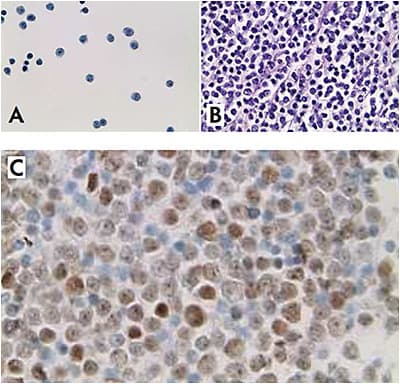 FIGURE 2: Thin prep slide (A) and cell block (B) of anterior chamber paracentesis with malignant cells consistent with diffuse large B-cell lymphoma in 59-year-old patient. PAX5 positive staining (C) indicates a population of B cells.IMAGE COURTESY ALANNA JAMES, MD