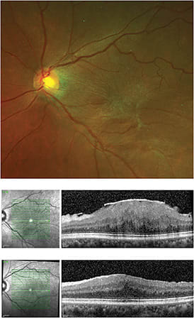 FIGURE 1: An idiopathic epiretinal membrane (ERM) that appears almost translucent on the inner surface of the internal limiting membrane (ILM) at the macula. Top: Color fundus photograph demonstrating incoherent retinal surface anatomy. Bottom: Optical coherence tomography cross-sectional image demonstrating a hyper-reflective lesion on the retinal surface with internal disorganization and thickening of the macula and fovea. Following removal, the individual layers of the retina are now more organized and vision is improved.IMAGE COURTESY ZACK OAKEY, MD