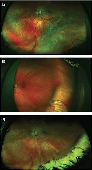 FIGURE 1. (A) 33-year-old female emmetrope post-Lasik (-6.25 pre-LASIK) presented with an inferotemporal retinal detachment with lattice degeneration and atrophic holes. (B) A 510 segmental buckle was placed in the inferotemporal quadrant. (C) Post BCVA refraction was unchanged and vision was 20/20 uncorrected.