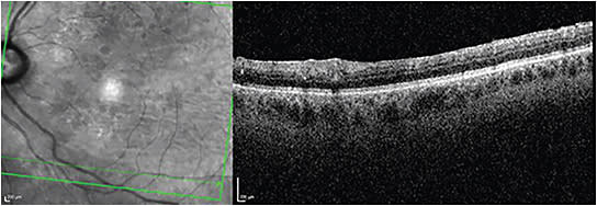 FIGURE 3: Macular OCT of the left eye demonstrating perivascular lesions, mild epiretinal membrane, and a few discrete areas of shadowing/transmission defects. IMAGE COURTESY BETH SNODGRASS