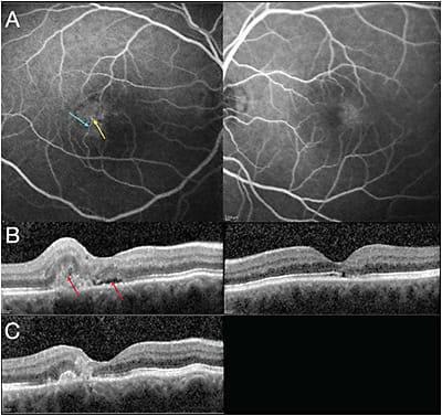 FIGURE 3. Fluorescein angiography and optical coherence tomography of a patient with neovascular macular telangiectasia. Yellow arrow (A) highlights an aneurysmal vascular change; blue arrow shows a proximal anastomosis. Imaging with Heidelberg OCT (B) reveals new subretinal fluid with intraretinal disorganization (most probably indicated intraretinal fluid) out of proportion to what is found in the contralateral eye. After the patient is treated with anti-VEGF injection (C), disorganization or intraretinal fluid and subretinal exudative fluid findings are resolved and the patient’s acuity returns to baseline. IMAGE COURTESY ZACK OAKEY, MD