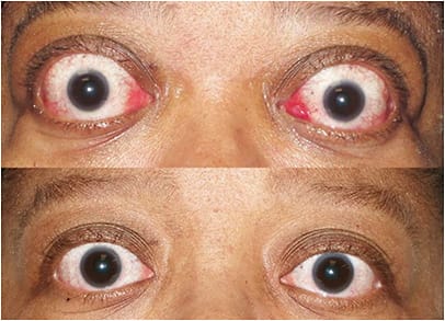 Figure 4. Top: A patient with active TED. Bottom: Patient shown again after receiving teprotumumab infusions (TEPEZZA, Horizon Therapeutics). IMAGES COURTESY HORIZON THERAPEUTICS.