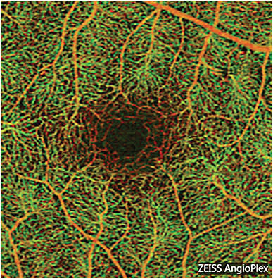 This color depth-enhanced OCTA image illustrates superficial vasculature (orange) and deep retinal plexus vessels (green).IMAGE COURTESY DARRIN A. LANDRY, CRA, OCT-C