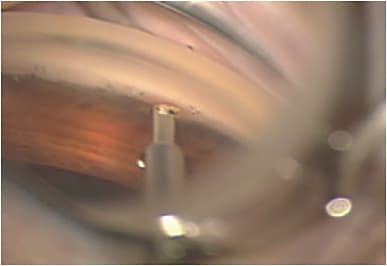 Figure 1: View of the angle through the goniolens during angle-based MIGS surgery.