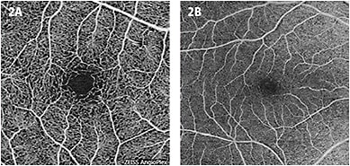 Figure 2. Normal macula on OCTA 3x3mm (A) and 6x6mm (B).