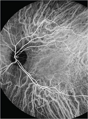 ICG angiography allows clinicians to visualize dynamic blood flow in the choroid.COURTESY DARRIN LANDRY, CRA, OCT-C