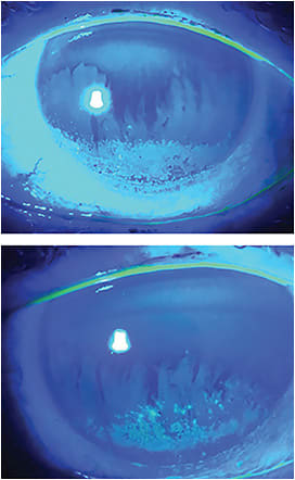Fluorescein staining pre-op can suss out asymptomatic patients.COURTESY DARRELL E. WHITE, MD