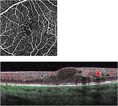 Figure 6. A. Superficial retinal vessels in a patient with MacTel. B. “Flow” B-scan OCT in same patient.