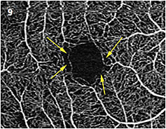 Figure 9. Possible early changes in the parafoveal capillaries in a diabetic patient.