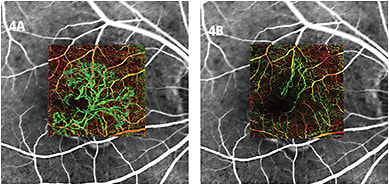 Figure 4. A. Baseline OCTA overlaid on FA. B. One-month follow up after anti-VEGF treatment.