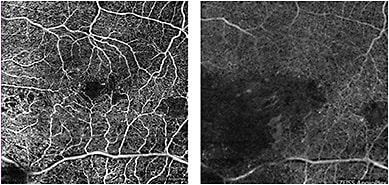 Figure 5. A. Superficial retinal vessels in a patient with branch retinal vein occlusion. B. Deep retinal plexus vessels in same patient.