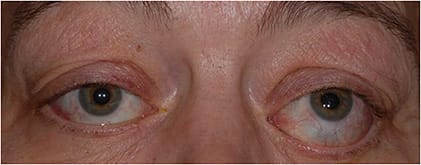 Figure 1. Active TED with worsening proptosis, lower eyelid retraction, inferior scleral show, and restrictive strabismus causing diplopia. This patient had undergone orbital decompression and eyelid surgery to correct eyelid retraction several years prior before experiencing a recurrence of active TED.Image courtesy Shakthi Kanagalingam, MD.