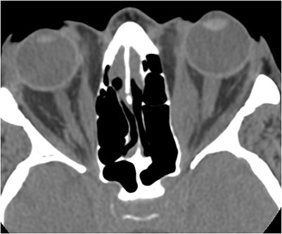 Figure 3A. Axial CT image demonstrating enlargement of the medial rectus muscle in each orbit. Image courtesy Shakthi Kanagalingam, MD.