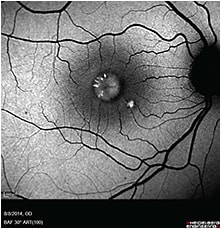 Fundus autofluorescence image of Best&#x27;s vitelliform macular dystrophy. IMAGE COURTESY OF HOLLY CHESHIER, CRA, OCT-C, COT, FOPS