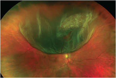 Fundus photo of retinal detachment with lattice.IMAGE COURTESY OF HOLLY CHESHIER, CRA, OCT-C, COT, FOPS