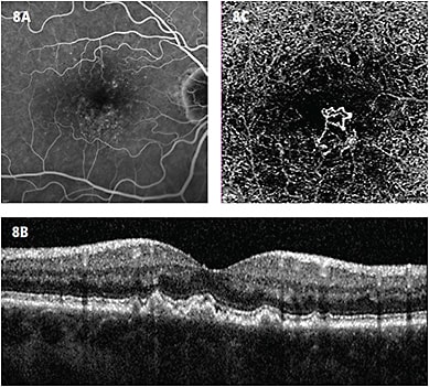 Figure 8. A. Late-phase FA showing drusen staining. B. OCT of same patient showing drusen. C. CNV seen at the RPE level on OCTA.