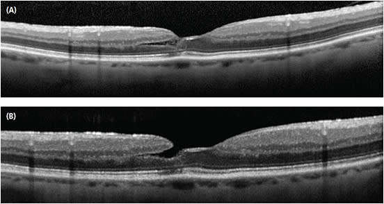 Figure 4. (A) Line scan relying on patient fixation. (B) Moving the line scan to better illustrate a lamellar hole.IMAGES COURTESY OF DARRIN LANDRY