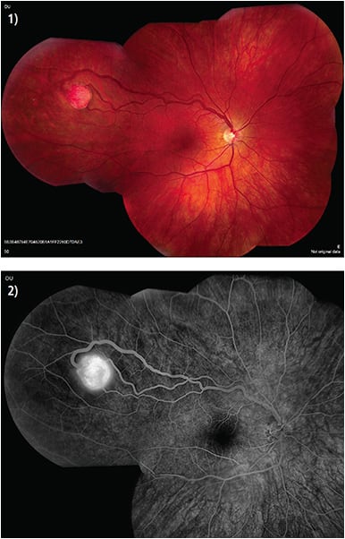 Von Hippel angioma is shown in 1) a color photo and 2) fluorescein angiography. IMAGES COURTESY OF HOLLY CHESHIER, CRA, OCT-C, COT, FOPS