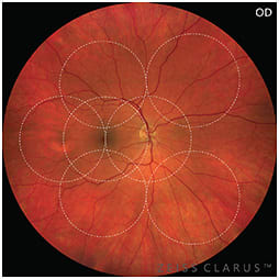 A first capture 133º FOV true color image from the Zeiss Clarus. Highlighted are the Early Treatment Diabetic Retinopathy Study’s specified 7 fields of the retina. IMAGE COURTESY ZEISS