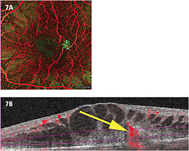 Figure 7. A. Color depth-encoded OCTA of RAP lesion (in green). B. “Flow” B-scan OCT in same patient. Yellow arrow indicates RAP vessel.