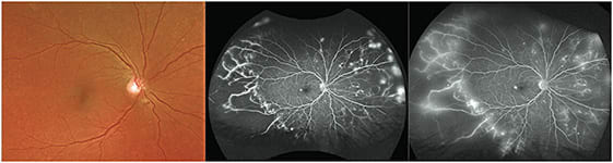 This 61-year-old type 2 diabetic female was visually asymptomatic with 20/30 vision. The macular region showed virtually no diabetic changes (left). However, Optos UWF FA showed severe peripheral ischemia with extensive areas of retinal neovascularization at the border between perfused and nonperfused retina (middle and right).IMAGE COURTESY STEVE BLOOM, MD