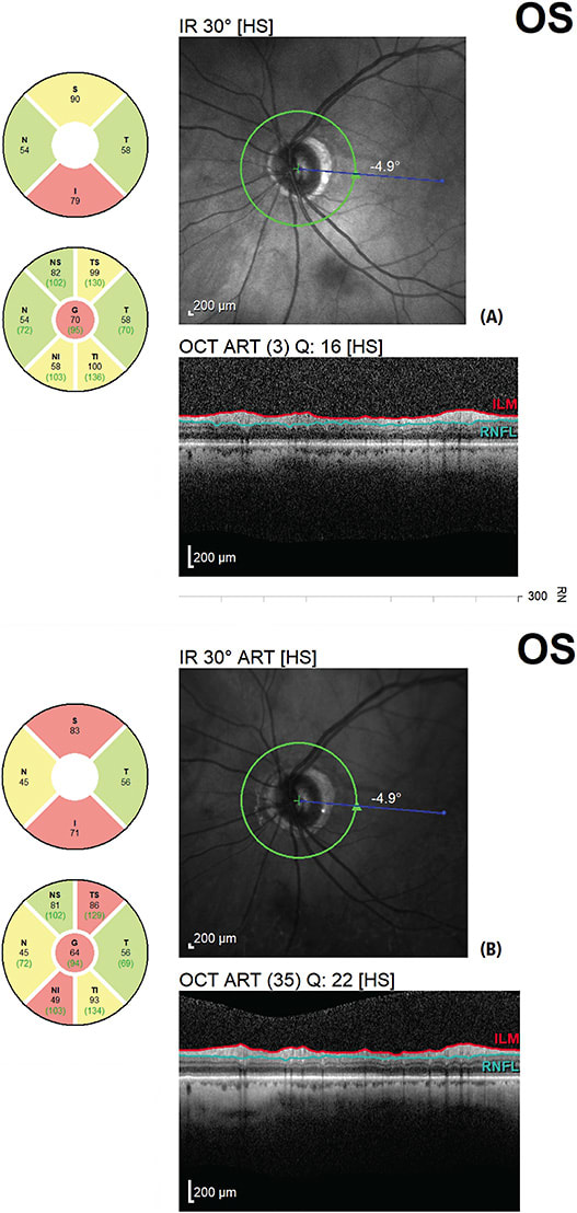 Figure 3. (A) RNFL analysis with focus on the laminae cribrosa. (B) Same analysis with focus on the nerve fiber layer levelIMAGES COURTESY OF DARRIN LANDRY