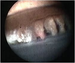 Figure 4: The endoscope view on the monitor during endoscopic cyclophotocoagulation (ECP) shows the treated ciliary processes on the left with shrinkage and whitening, compared to untreated ciliary processes on the right.